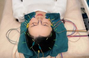 美容鍼 睡眠 自律神経