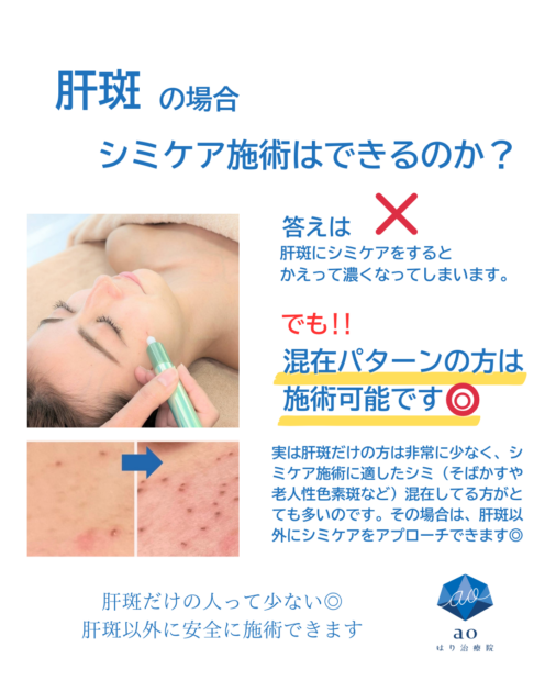 名古屋 シミ 痛くない