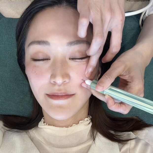 シミケア シミ そばかす