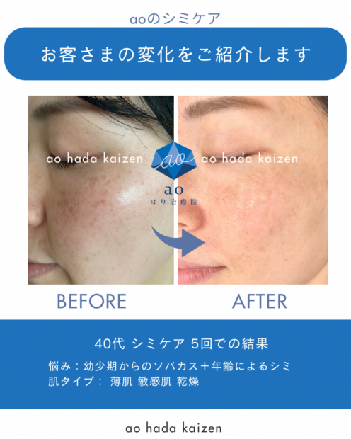 名古屋 シミ取り 痛くない