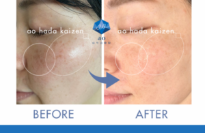 名古屋 シミ 痕にならない