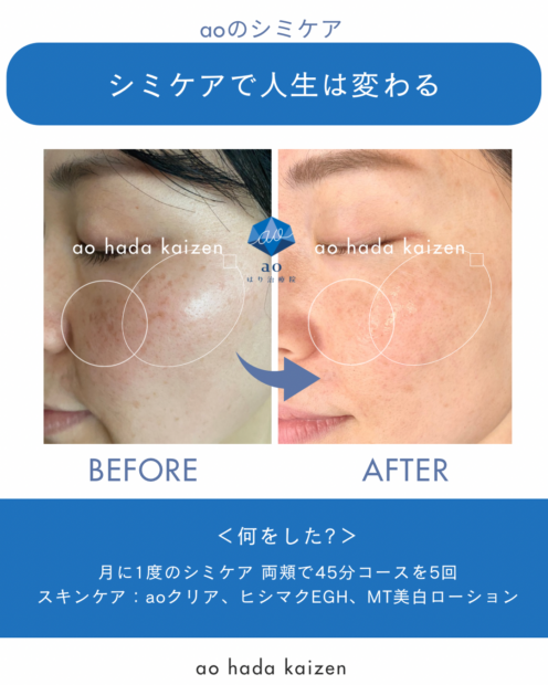 名古屋 シミ 痕にならない