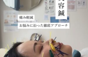 名古屋 美容鍼 おすすめ
