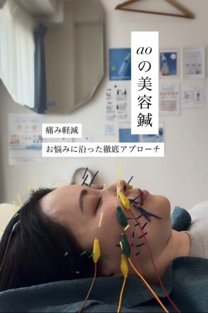 名古屋 美容鍼 おすすめ