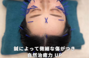 美容鍼 名古屋 おすすめおすすめ